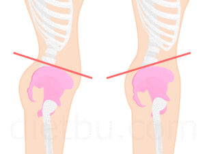 骨盤の前後の歪み